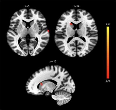 Distinct Insular Functional Connectivity Changes Related to Mood and Fatigue Improvements in Major Depressive Disorder Following Tai Chi Training: A Pilot Study